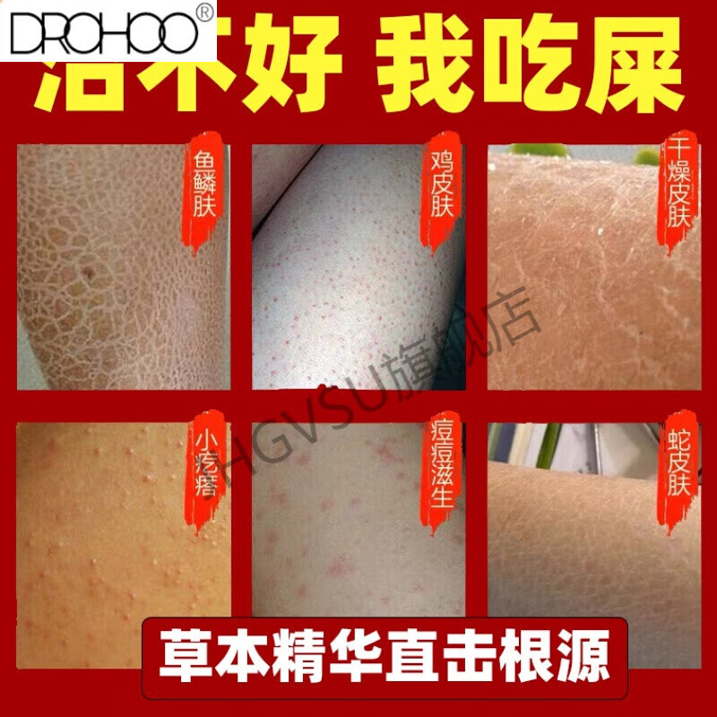 大腿上鸡皮肤红色斑点(为什么鸡皮肤会出现很多红点) 大腿上鸡皮肤红色斑点(为什么鸡皮肤会出现很多红点)