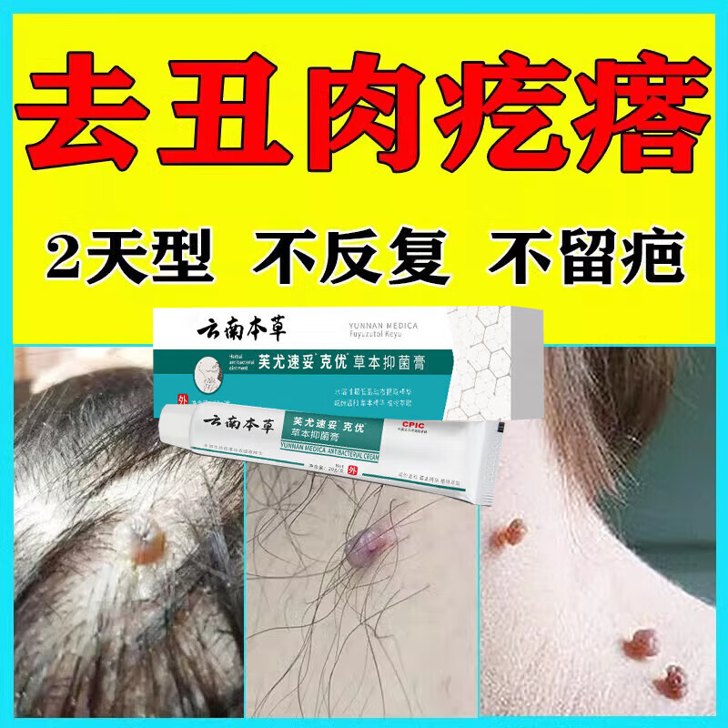 疣瘊灵去除脖子小肉粒去肉瘤肉痣小肉揪药膏去除尤去猴子肉粒疙瘩肉刺