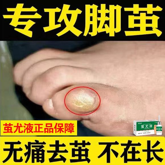 凝昔雅去老茧脚垫手茧关节茧脚底脚掌死皮厚茧脚后跟厚硬皮足部去茧神器 茧尤液一瓶装轻度者