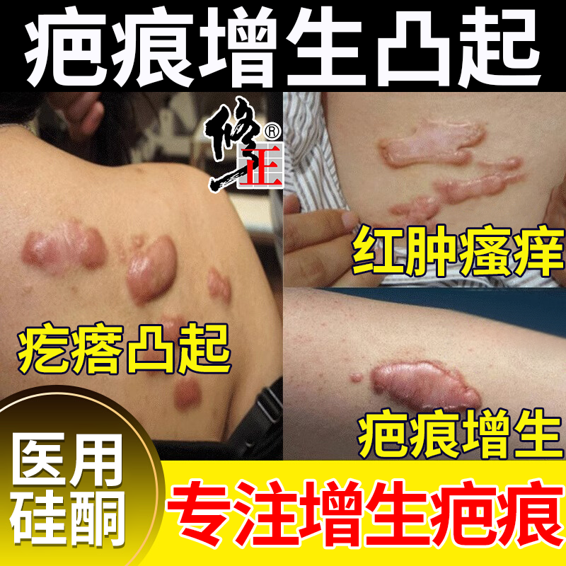 【医用推荐】疤痕增生凸起去除疙瘩止痒胸口瘢痕疤痕体质硬肉疙瘩去