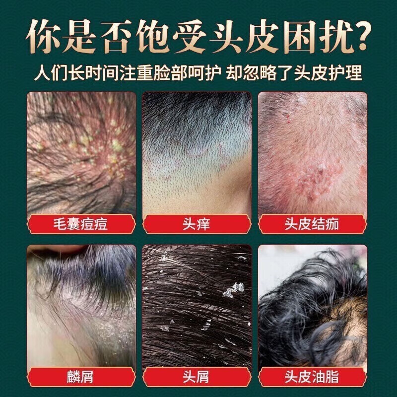 云南本草头皮毛囊宁炎洗发水可搭去屑控油脂溢性 1瓶装300ml