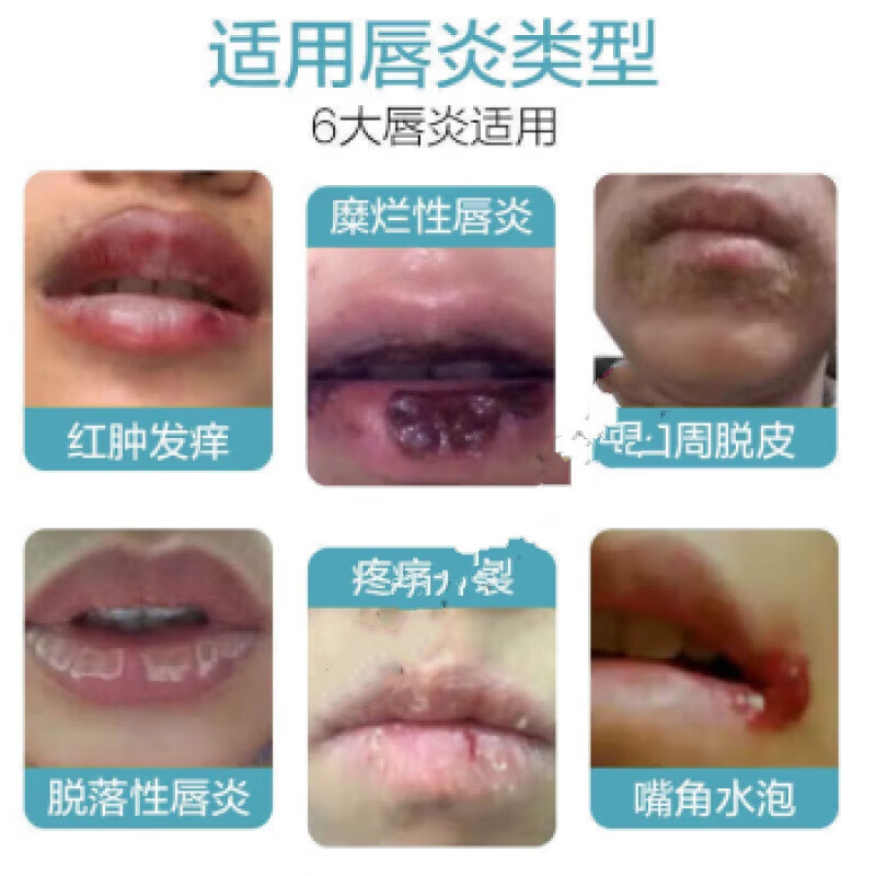 澳德力康嘴角溃烂软膏口角炎修复膏烂嘴角秋冬干裂开裂起泡溃烂疼痛红肿发 买3+2【五盒巩固装】，
