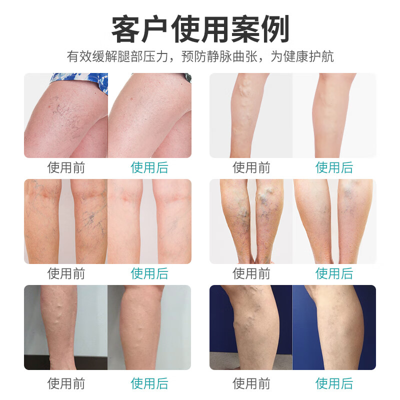 正人之本防静脉曲张弹力袜Ⅱ二级压力袜医用级治疗型抗血栓抗水肿术后恢复 【医用薄款】长筒露趾 黑色 二级压力 XXL码 参考体重150斤以上