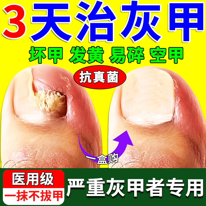 灰指甲专用药灰指甲根裉治正品甲沟炎灰指甲药膏指甲真菌感染脱甲坏甲