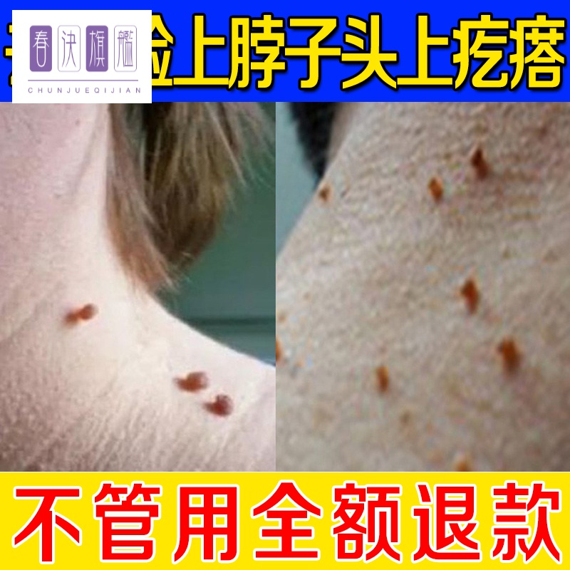 去除脖子小肉粒祛刺痦子去除膏去猴子脖子上长小肉粒疙瘩皮赘肉瘤凸痣