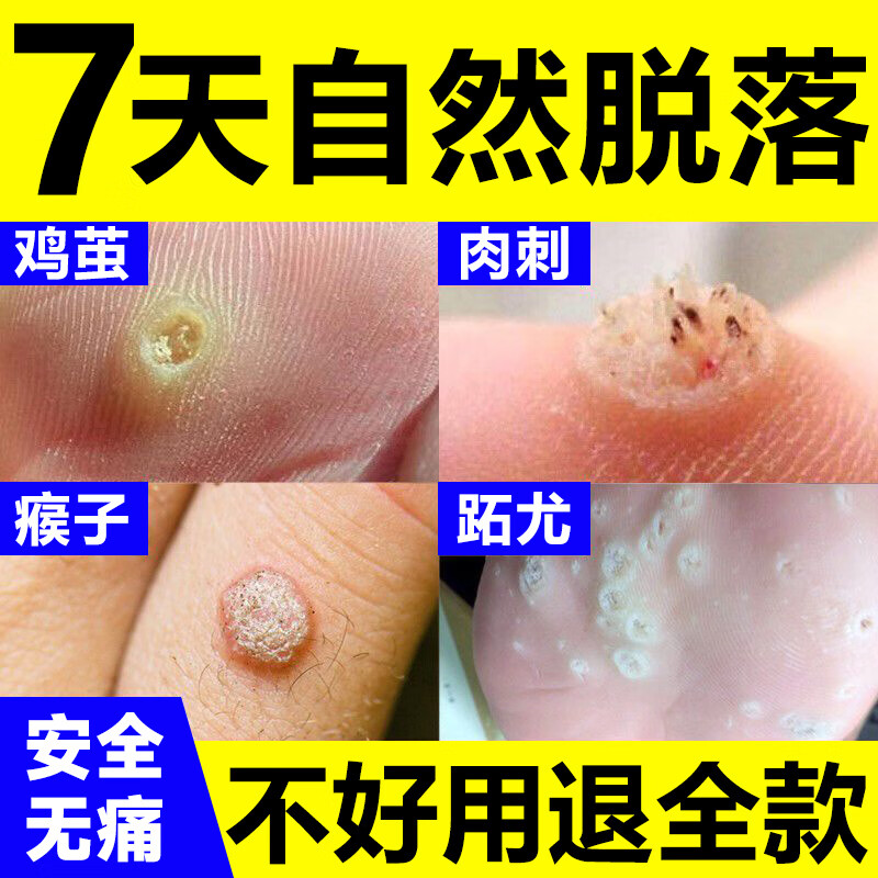 贴膏脚趾跖疣瘊子去除手部肉刺脚药鸡尤净专用根 1盒