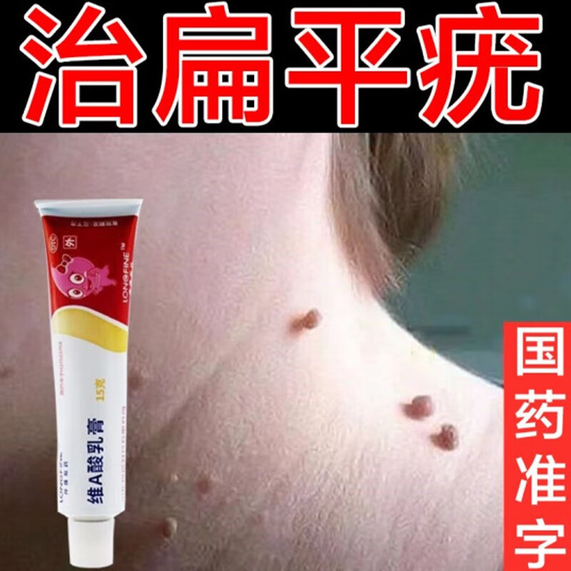 扁平疣专用药丝状疣脖子颈部脖子长肉粒面部瘊子去除肉刺药膏脖子长肉