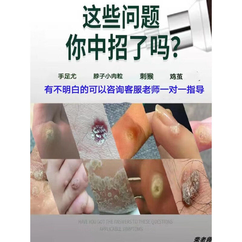 【jd健康】猴子药跖疣专用膏去瘊灵肉粒疙瘩拓疣鸡眼膏贴肉刺趾尤
