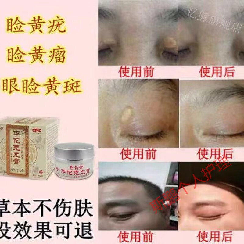 除睑黄疣圆眼部睑黄瘤膏除汗管瘤眼皮脸黄斑圆膏睑眶康瘤眼眶周