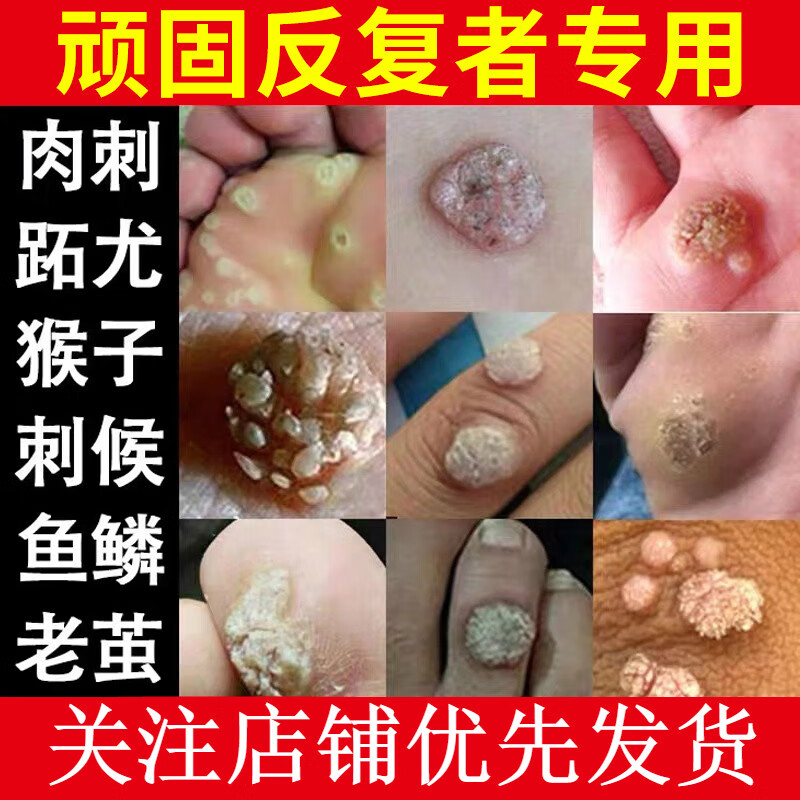 刺猴去除专用去肉粒疙瘩猴子鱼鳞痣鸡眼祛瘊子神器手部足部肉刺膏