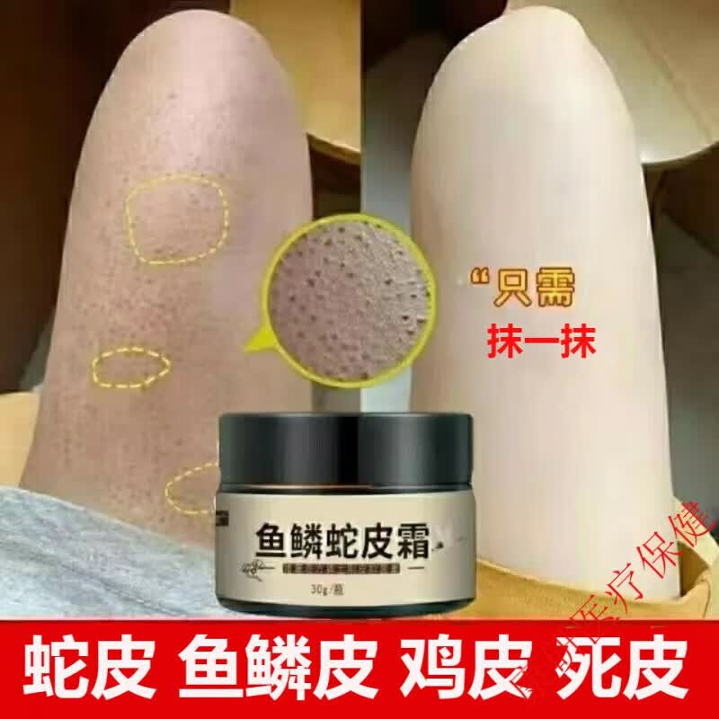 鸡皮肤霜鱼鳞皮肤蛇皮肤软膏【秋冬护肤】大小腿部鳞屑干燥纹路脱皮起