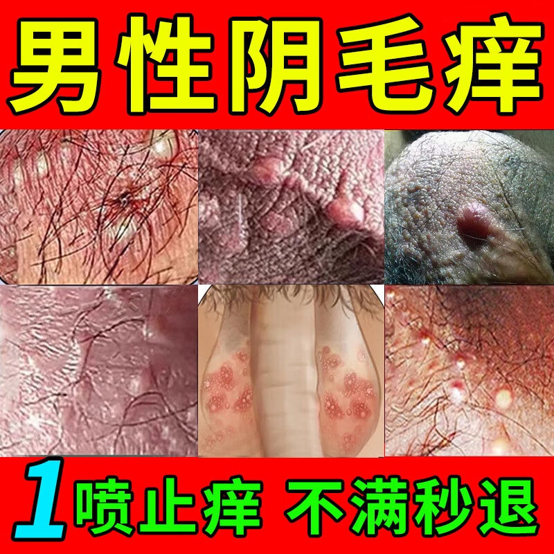 男性阴部毛下瘙痒男人下体私处阴部长疙瘩毛囊炎红肿疼痛长痘痘治真菌
