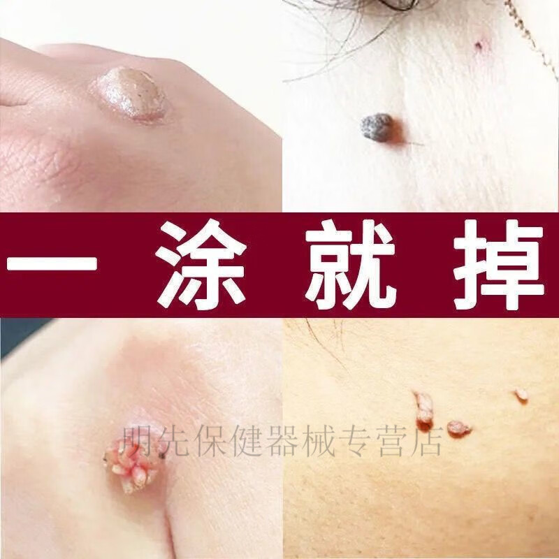 【专攻去疣】去除脖子小肉粒赘皮扁平尤祛疣瘊丝状尤腋下小猴子膏abay