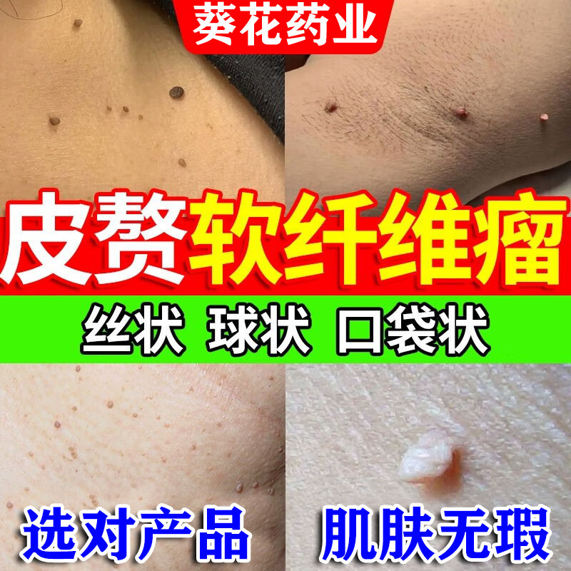葵花皮肤软纤维瘤药皮赘专用凝胶可搭软纤维瘤药膏皮赘肉粒去除神器