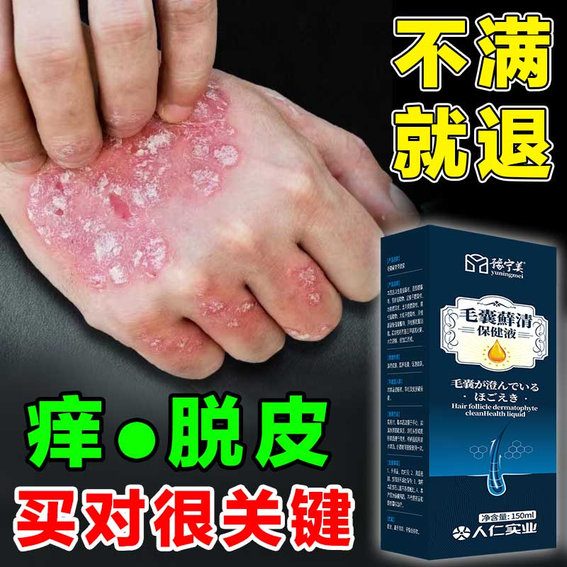 牛皮癣沐浴露专用顽固牛皮癣银屑藓外用沐浴露股癣手足癣本草净顽 单