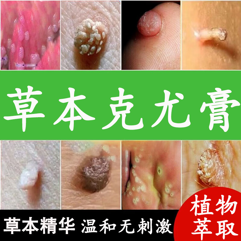 草本克优膏官方店旗舰克疣膏克尤膏草木优膏脖子肉粒丝状疣祛尤膏脸上