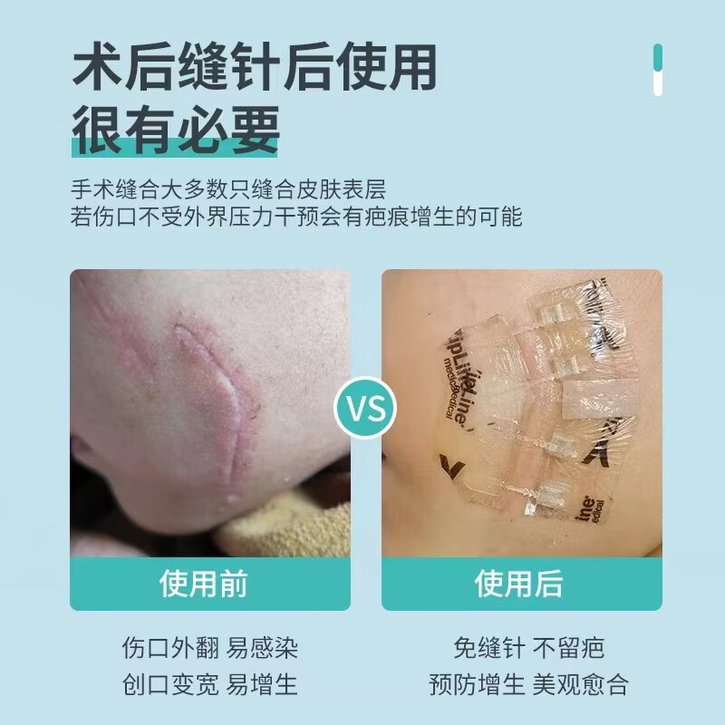 实情必读九院同款儿童医用缝合器怎么样？红色评测插图