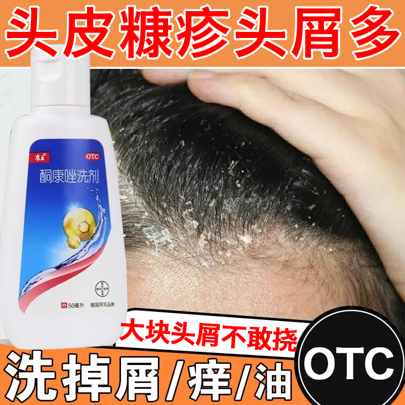 康王 酮康唑洗剂 50ml 头皮瘙痒满头头皮屑专用药头皮糠疹脂溢性皮炎
