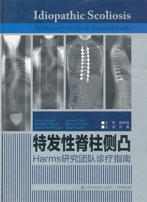 特发性脊柱侧凸