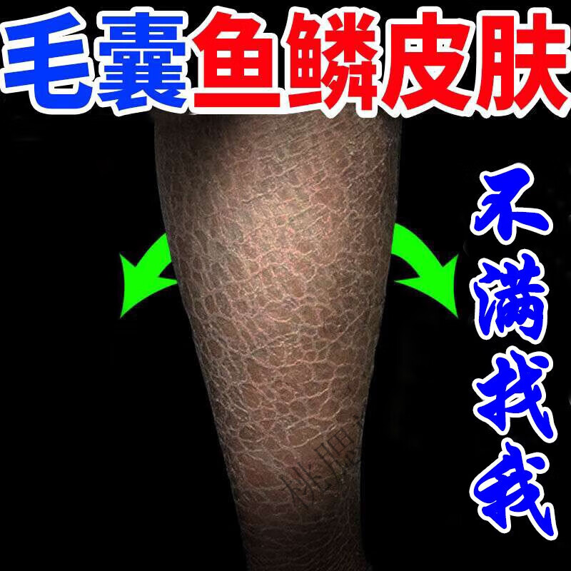 鸡皮肤要趁早治疗吗(鸡皮肤治疗的话要多久才能治好?) 鸡皮肤要趁早治疗吗(鸡皮肤治疗的话要多久才能治好?)