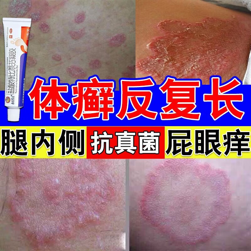 铜钱癣专用药膏 治真菌感染引起头癣手癣足癣体癣花斑癣股癣皮肤瘙痒