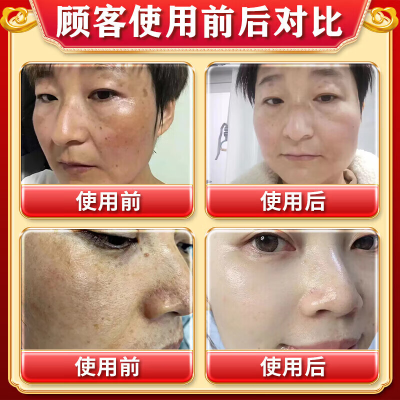 老年斑专用一夜消强力去除专用脸部手背祛斑霜专用强力去除沉淀祛 一盒
