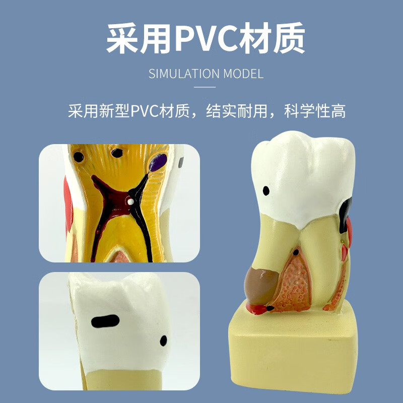 蛀牙模型 牙齿病综合病理模型 牙齿解剖剖面模型 牙齿 医患沟通 a款小