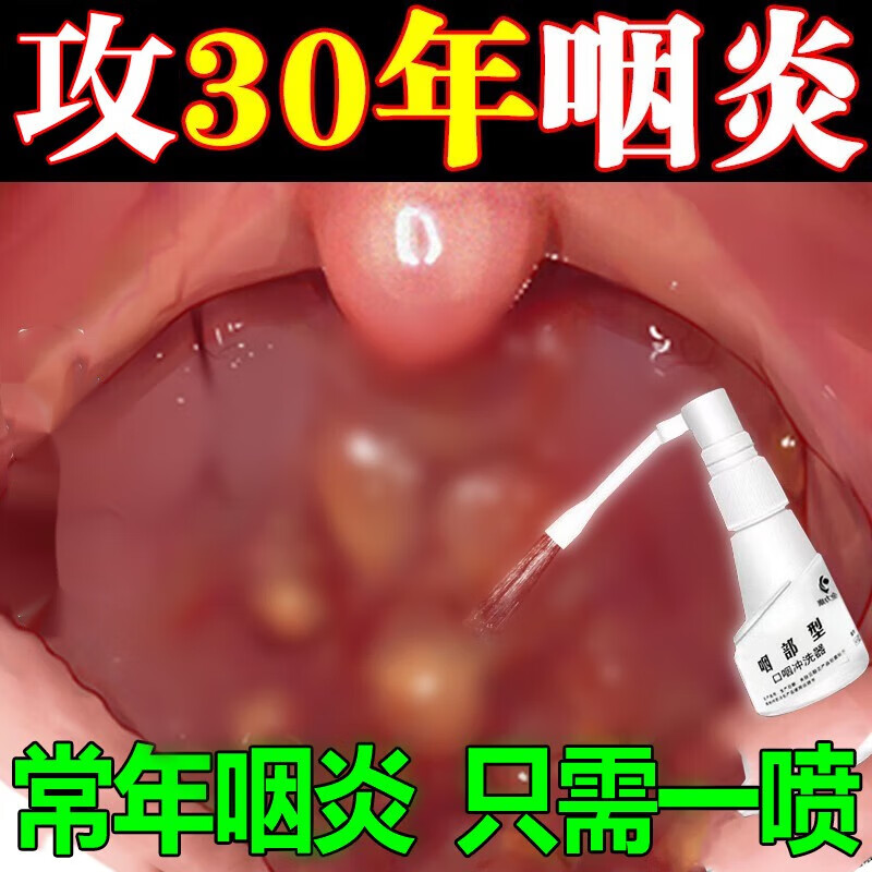 咽炎喷雾剂咳嗽咳喘痰多嗓子疼咽喉肿痛扁桃体发炎肥大去滤泡 一盒装