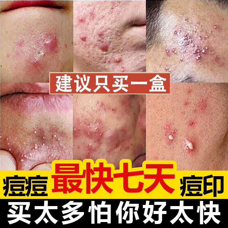 倾姿堂云南本草美白祛痘精华液淡化痘印提亮肤色收缩毛孔男女15ml