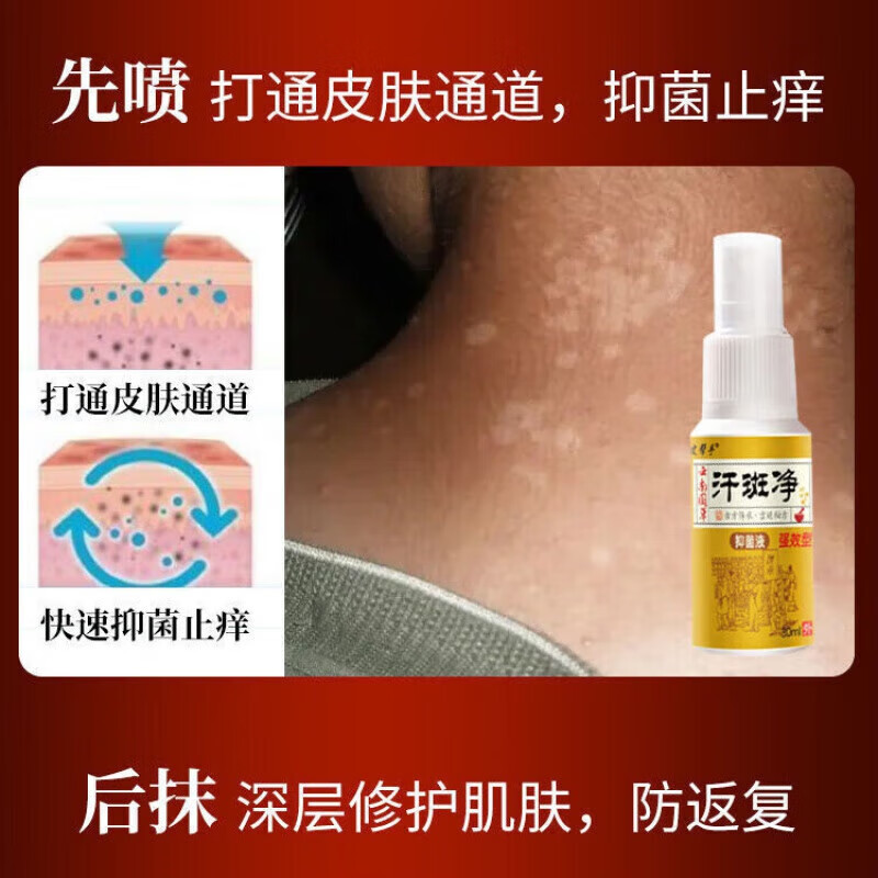 汗斑专用的药汗斑净白癜l风套装(喷剂 乳膏)胸前背部片状花斑火斑白斑