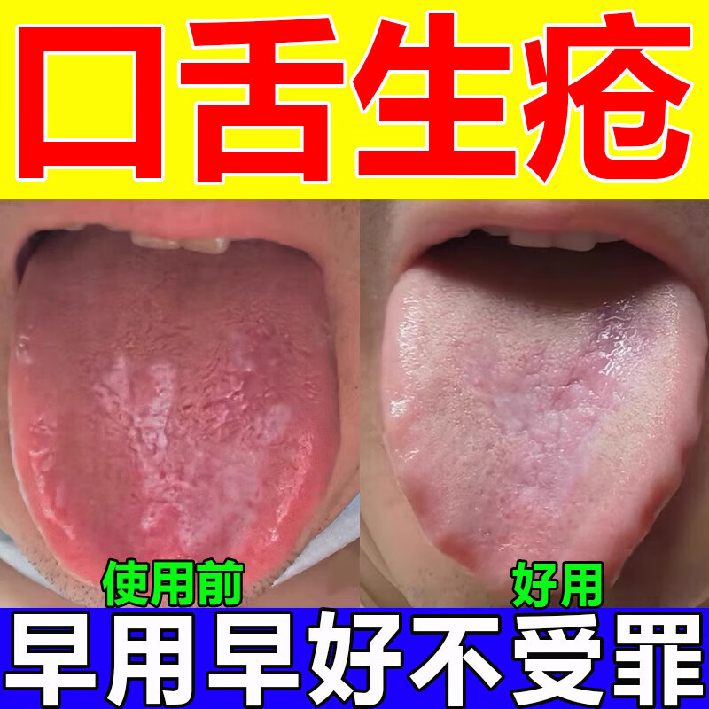 geox【官方】口腔扁平苔藓专用舌痛舌头白斑口腔溃疡糜烂舌炎舌裂