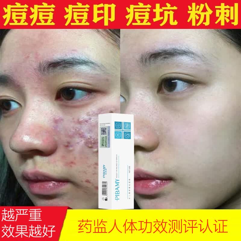 比芭美(pibamy)壬二酸祛痘凝胶15%水杨酸青春痘精华霜淡化痤疮祛痘膏