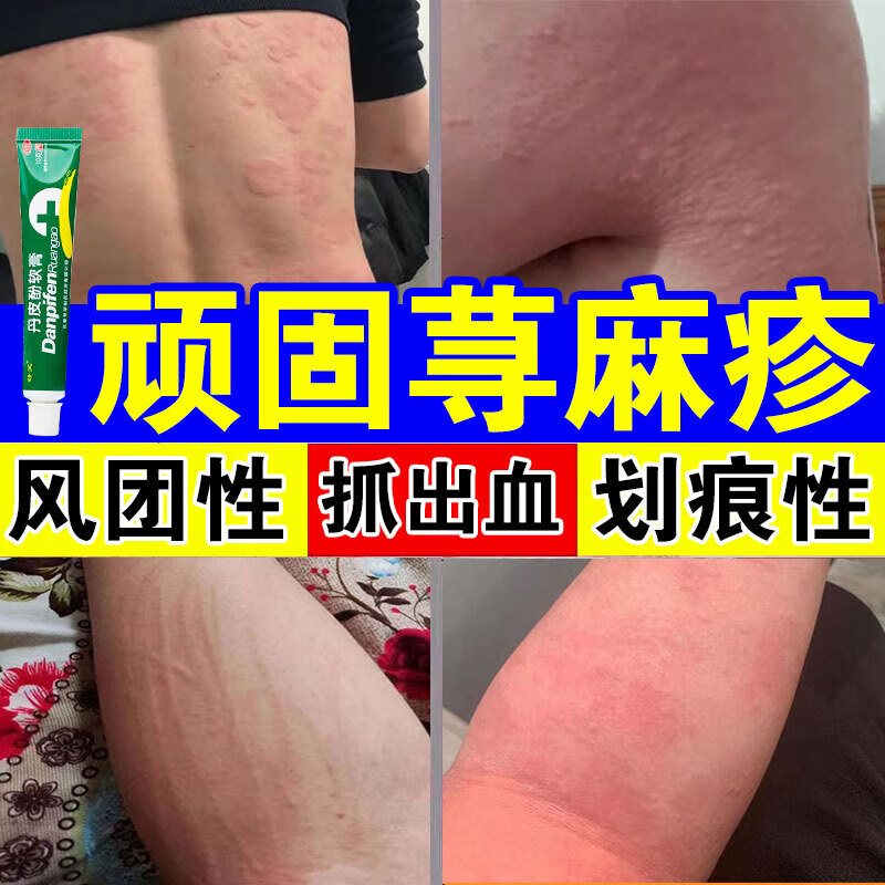 急慢性荨麻疹风团型划痕性胆碱性 丹皮酚软膏 5盒装【全身瘙痒】反复