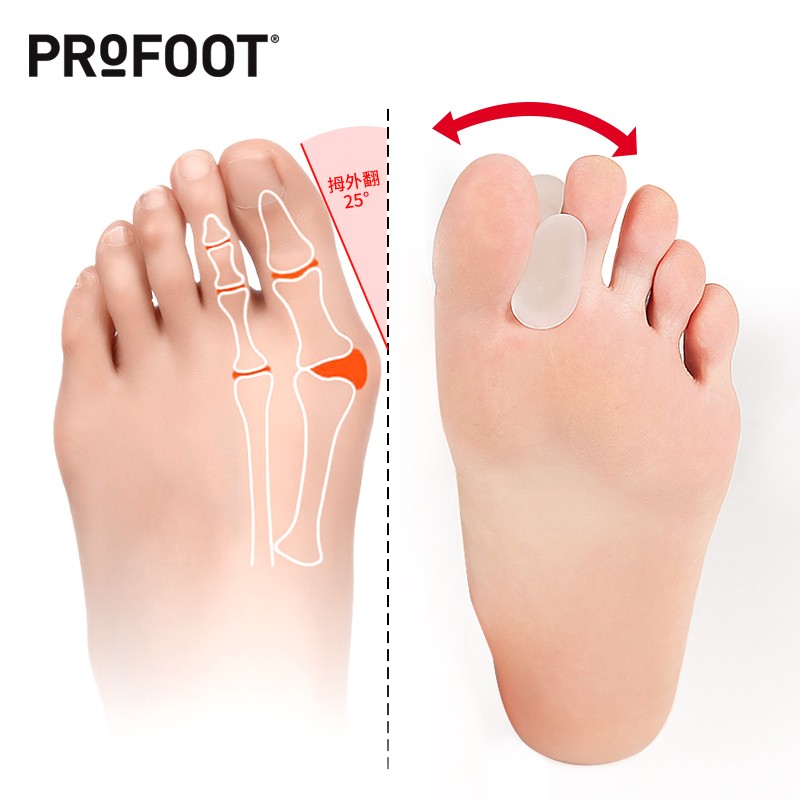 profoot拇指外翻分趾器大脚趾头大拇指大脚骨拇外翻女士可穿鞋姆脚