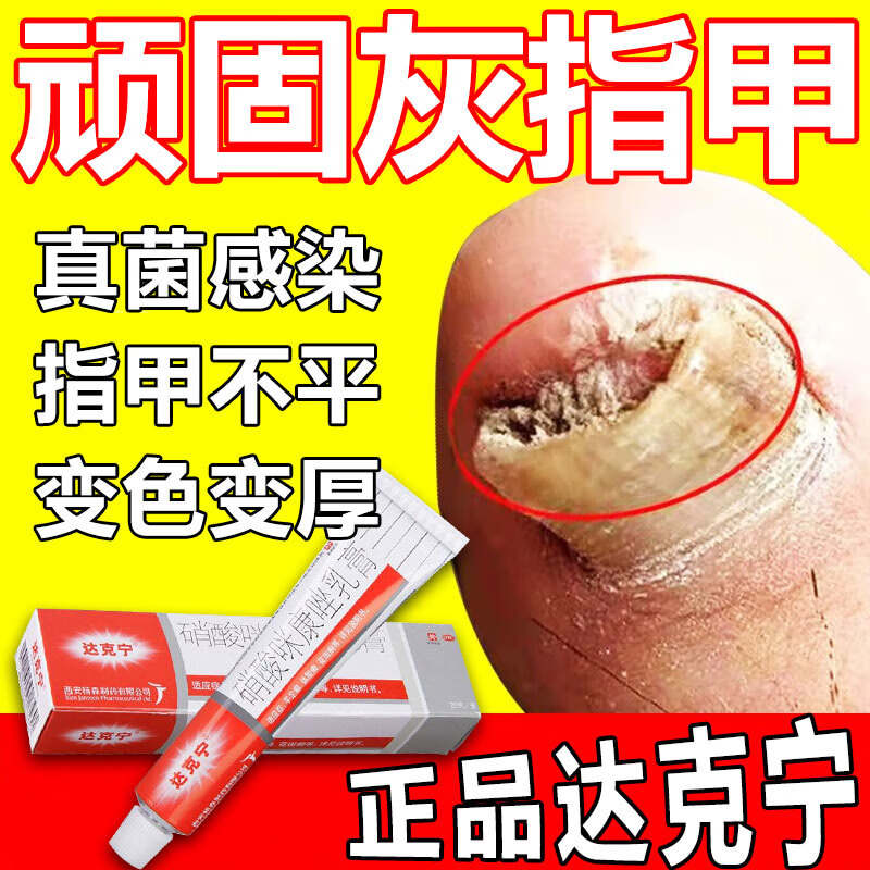 达克宁硝酸咪康唑乳膏 治疗甲癣灰指甲特厚药难治正i品可搭灰指甲药膏