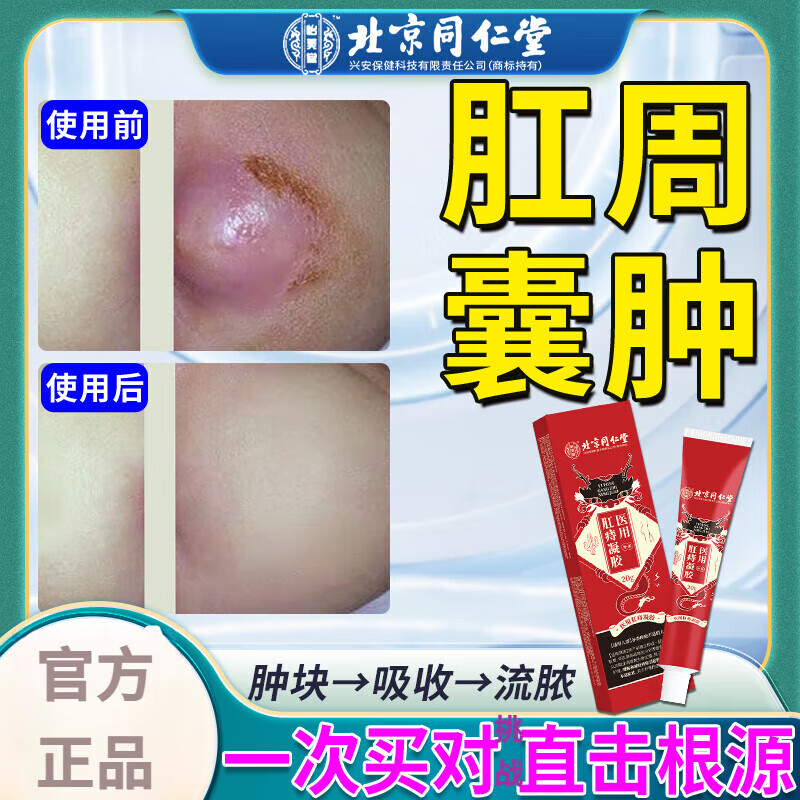 肛瘘非药特效 大便出血内口封口膏肛裂愈合肛周脓肿湿疹瘙痒肛瘘克的