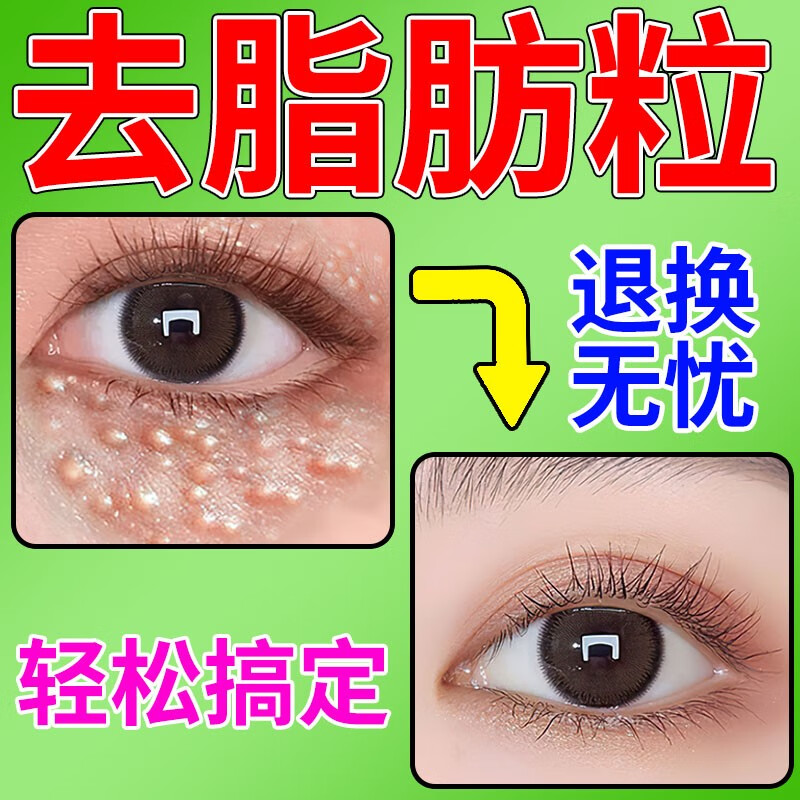 脂肪粒去除神器眼霜祛汗管瘤油脂粒油脂粒草本萃取男女眼部专用 单