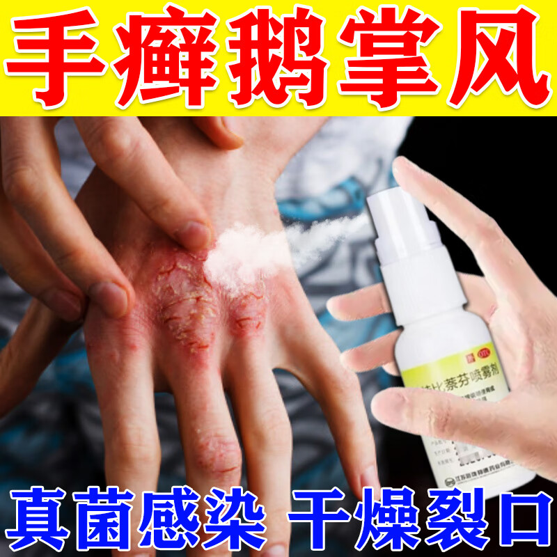 手癣专用药 治手干燥脱皮开裂真菌感染瘙痒起水泡湿疹汗疱疹鹅掌风