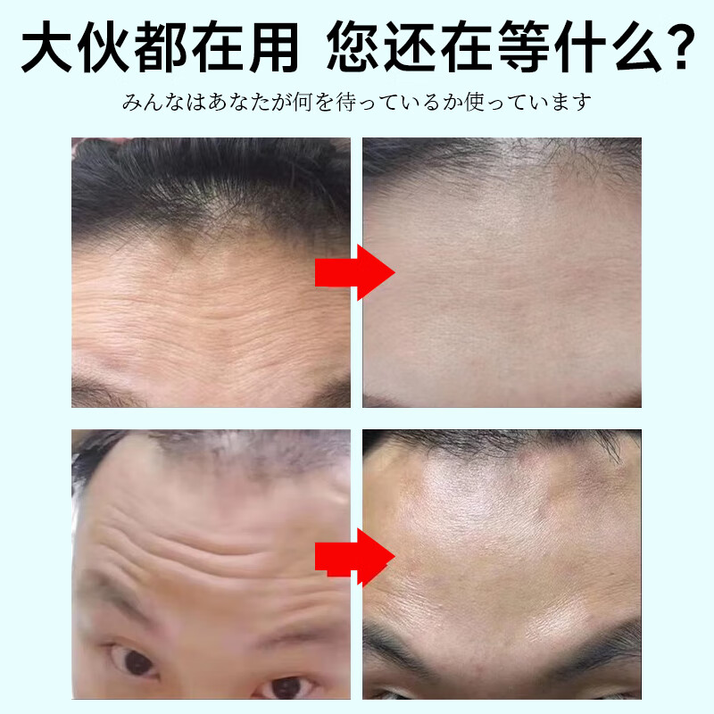H18抬头纹贴去除男女士额头川字纹皱纹贴法令纹提拉紧致30片装