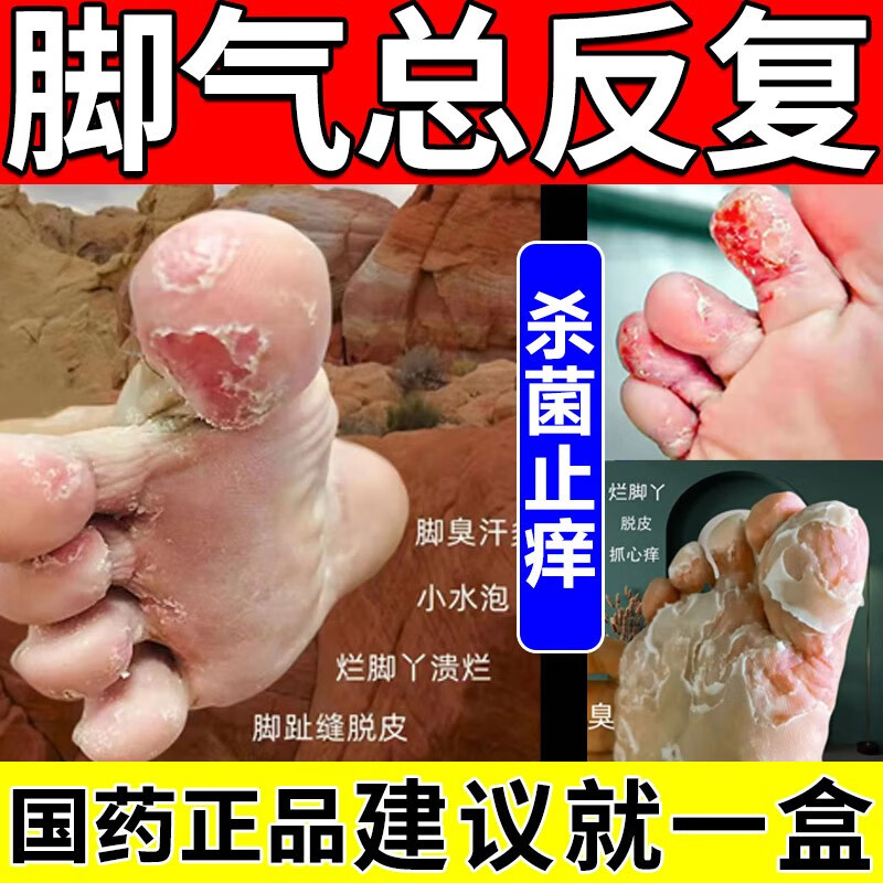脚气药止痒脱皮烂脚丫真菌感染止痒非根治脚臭脚出汗水泡糜烂脚气膏非