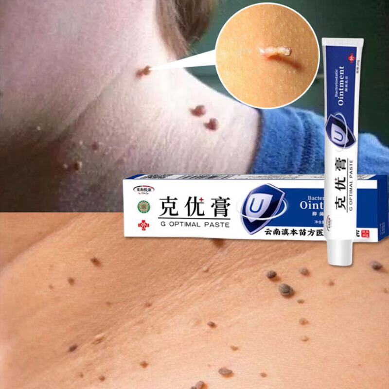 nurssiey扁毛霜苗药粉广东忠卡丹迪膏疣尤清宁脖子上的小肉粒咪喹i