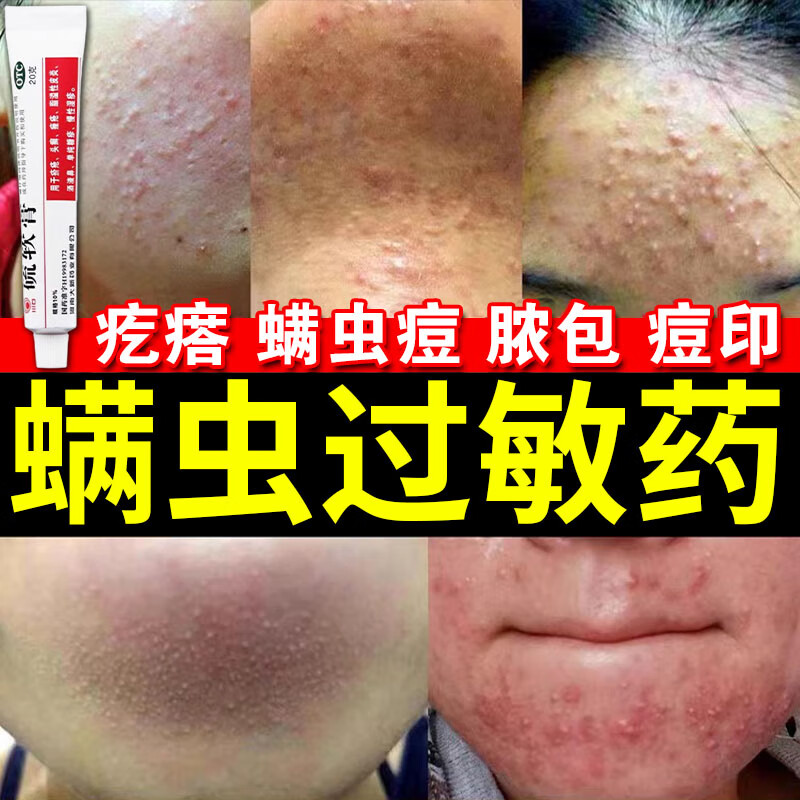 螨虫过敏药膏 螨虫叮咬止痒消肿毛囊炎背部专用药红疙瘩胸部脸部 皮肤