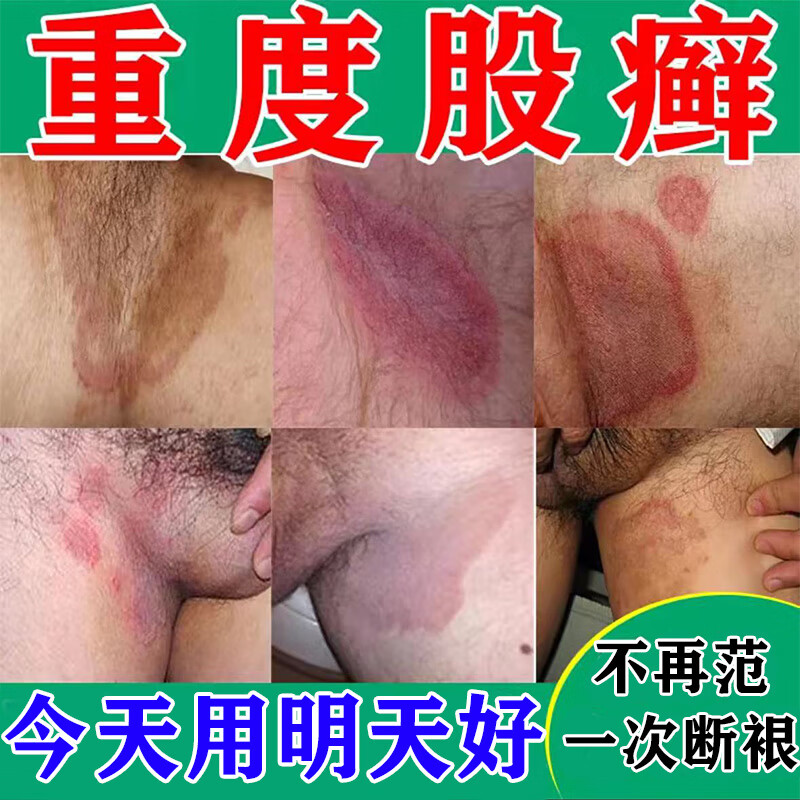 股癣专拥用药膏股癣膏大腿内侧阴囊私处瘙痒真菌感染止痒 一盒装