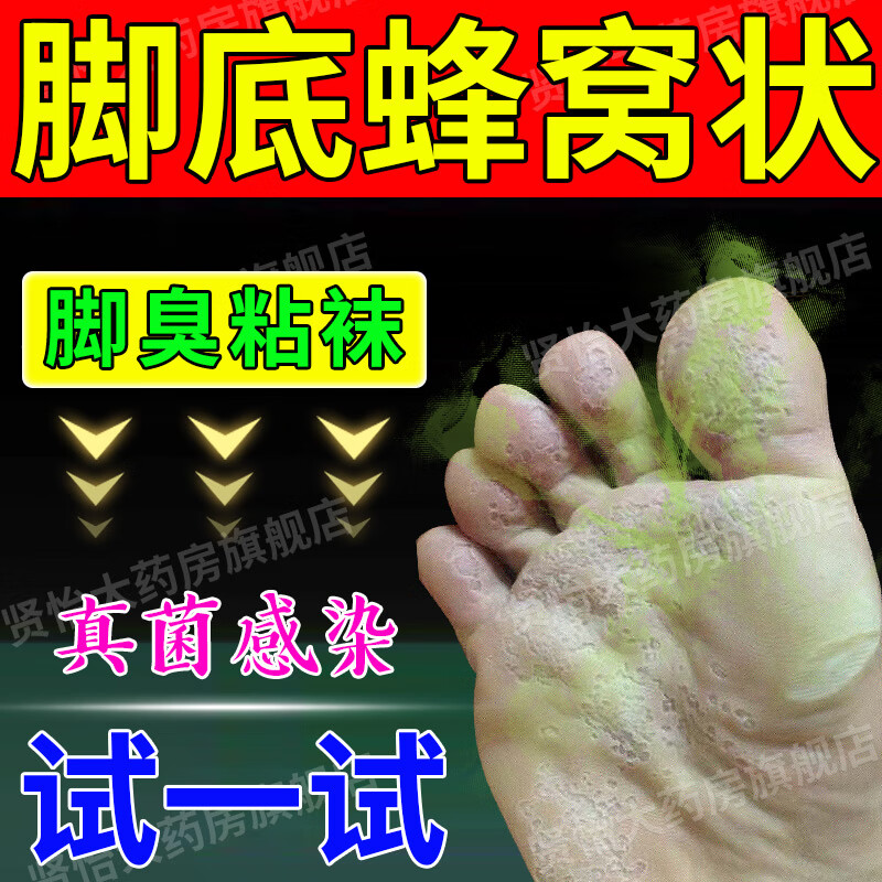 窝状角质松解症脚底马蜂窝脱皮水泡烂脚丫真菌感染足癣脚臭止痒 复方