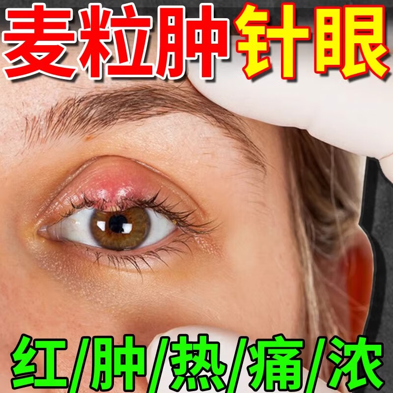 麦粒肿眼药水热敷贴眼膏睑板腺堵塞眼睑红肿痒脓痛模糊异物感去霰粒肿