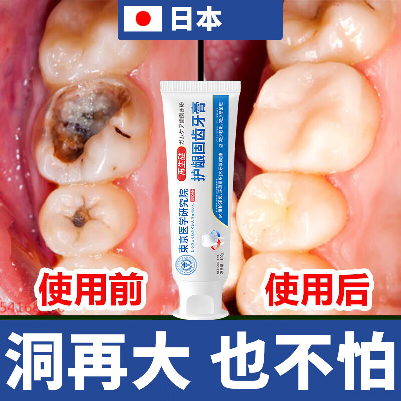 再生硅牙膏 日本牙洞膏牙缝补修复蛀牙坏牙烂牙自己填牙洞虫牙清 一盒装