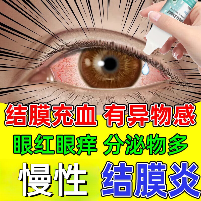 慢性结膜炎眼药水眼睛红肿滴眼液春季结膜炎眼涩发痒红血丝结膜充血