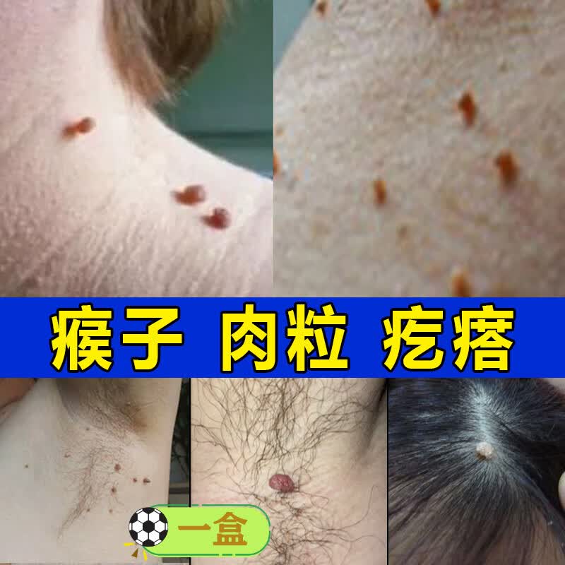 崽白瘊优偏方点刺猴去除去尤瘊l疣脖子上长小肉粒一抹无忧疙瘩祛除膏