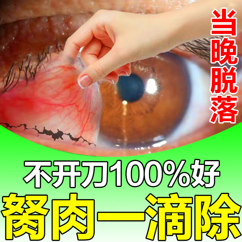 官方去除眼睛胬肉眼睛红血丝长胬肉有异物感视力模糊翼状胬肉眼干 单