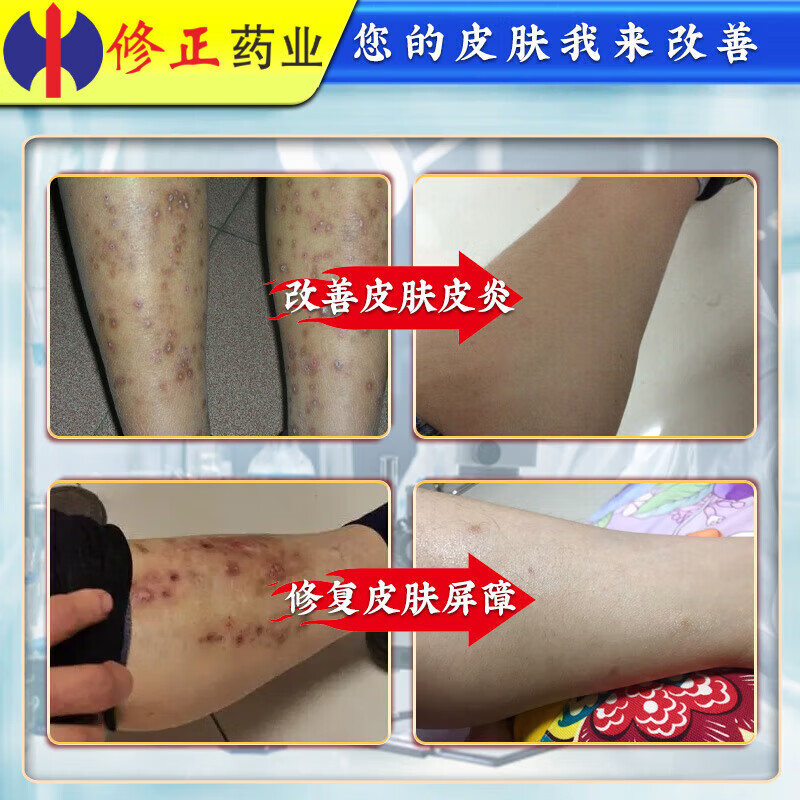 修正结节性痒疹药膏硬疙瘩皮肤瘙痒皮炎湿疹真菌感染止痒专用湿疹膏 买二送一【修正】
